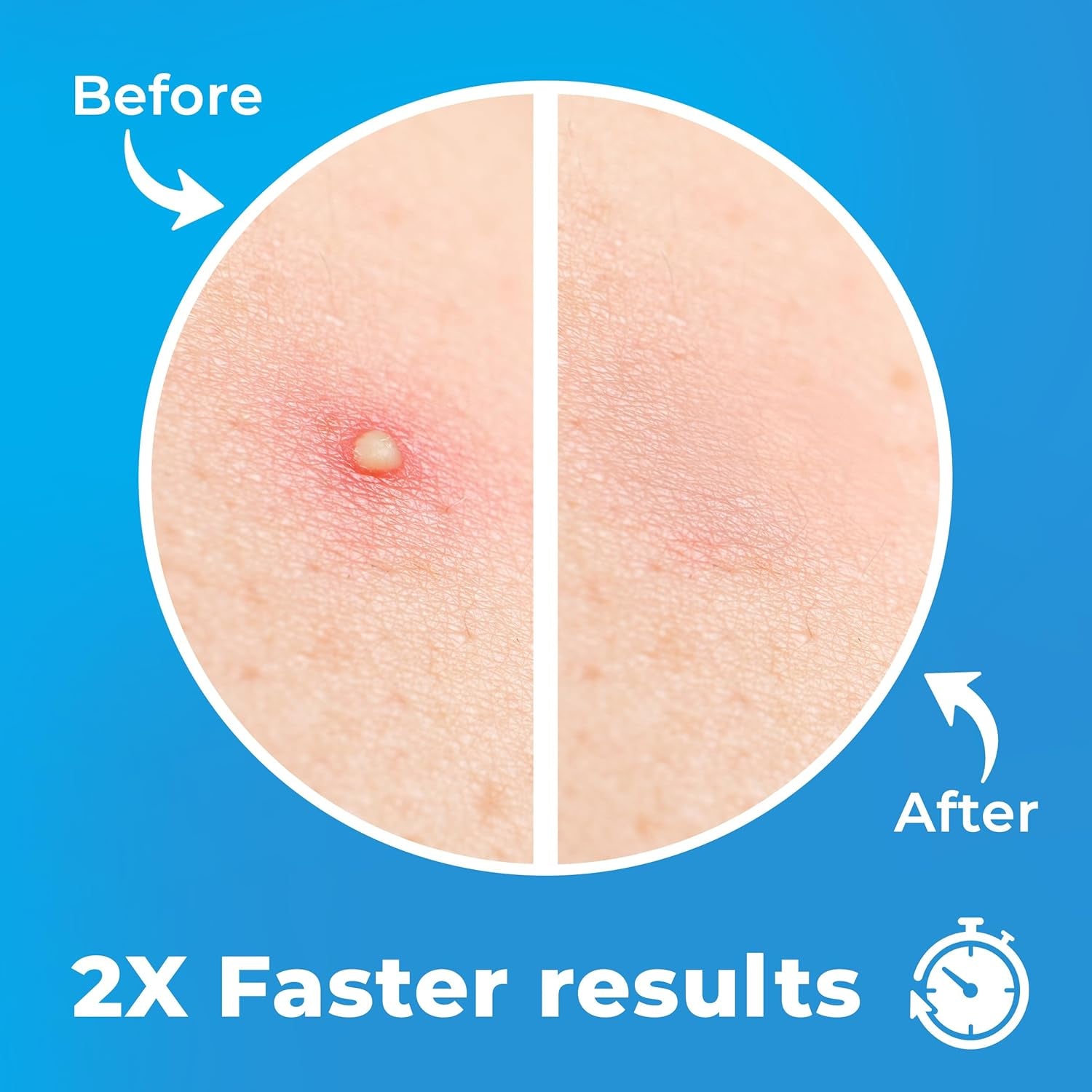 Pimple Patches for Face (120 Patches), Hydrocolloid Pimple Patches - Pimple Patch Zit Patch and Pimple Stickers - Hydrocolloid Pimple Dots for Pimples - Zit Patches