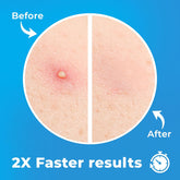 Pimple Patches for Face (120 Patches), Hydrocolloid Pimple Patches - Pimple Patch Zit Patch and Pimple Stickers - Hydrocolloid Pimple Dots for Pimples - Zit Patches