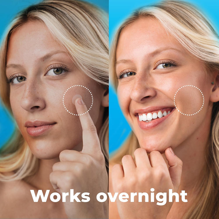Pimple Patches for Face (120 Patches), Hydrocolloid Pimple Patches - Pimple Patch Zit Patch and Pimple Stickers - Hydrocolloid Pimple Dots for Pimples - Zit Patches